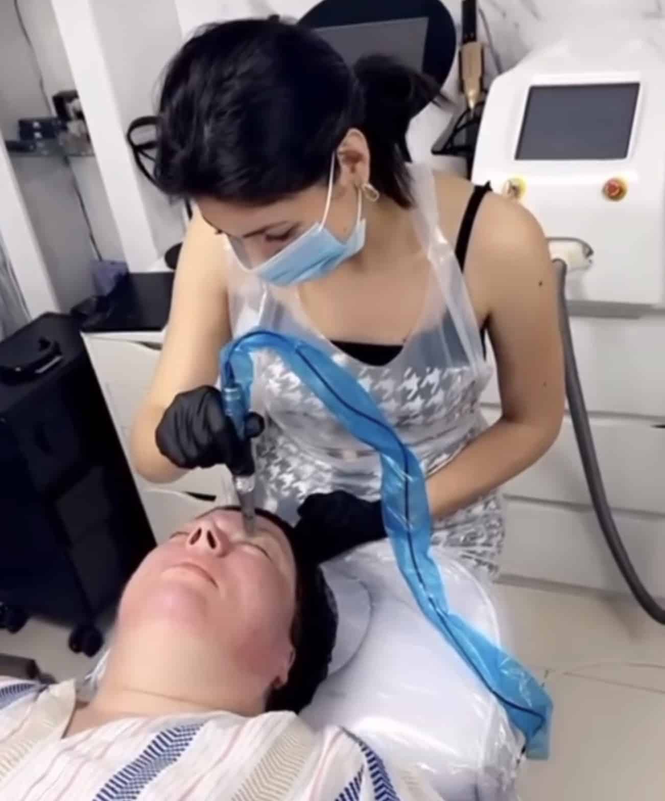 Microneedling behandeling